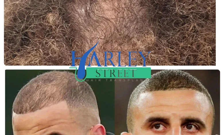 Hair Transplant