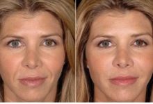 How Long Do the Results of a Restylane Treatment Find Out