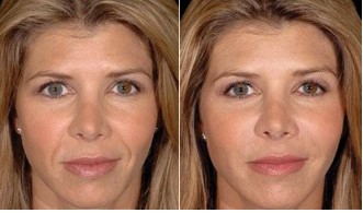 How Long Do the Results of a Restylane Treatment Find Out