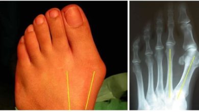 Is Bunion Surgery Right for You Key Information for Making an Informed Decision