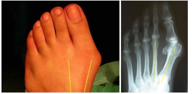 Is Bunion Surgery Right for You Key Information for Making an Informed Decision