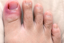 Who Is a Good Candidate for Partial Toenail Removal