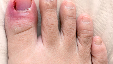 Who Is a Good Candidate for Partial Toenail Removal