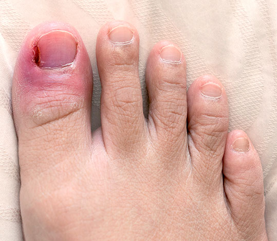 Who Is a Good Candidate for Partial Toenail Removal