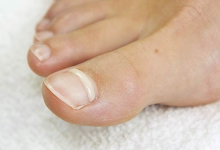 Why Should You Consider Ingrown Toenail Matricectomy for Chronic Pain