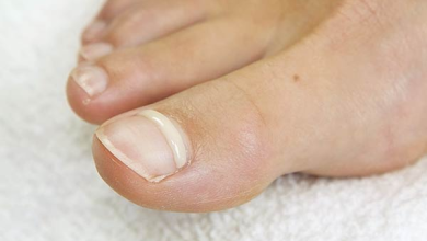 Why Should You Consider Ingrown Toenail Matricectomy for Chronic Pain