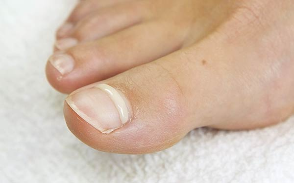 Why Should You Consider Ingrown Toenail Matricectomy for Chronic Pain